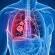 ¿Qué es un Tromboembolismo pulmonar?