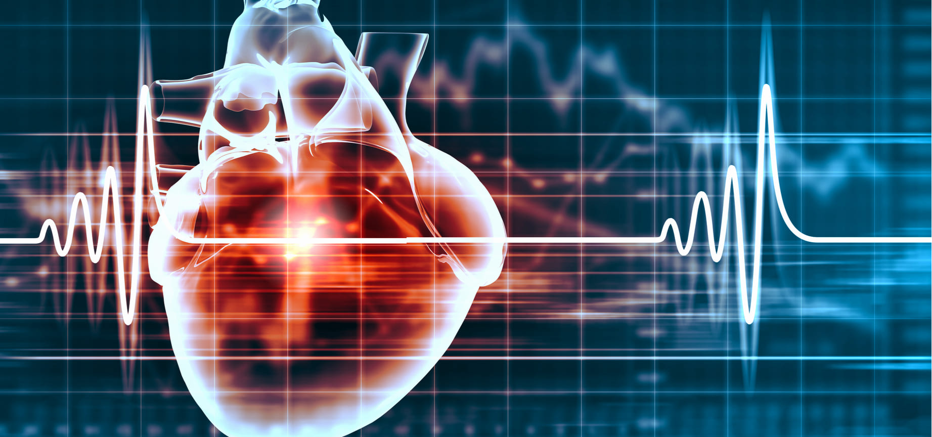 Qué es la taquicardia supraventricular