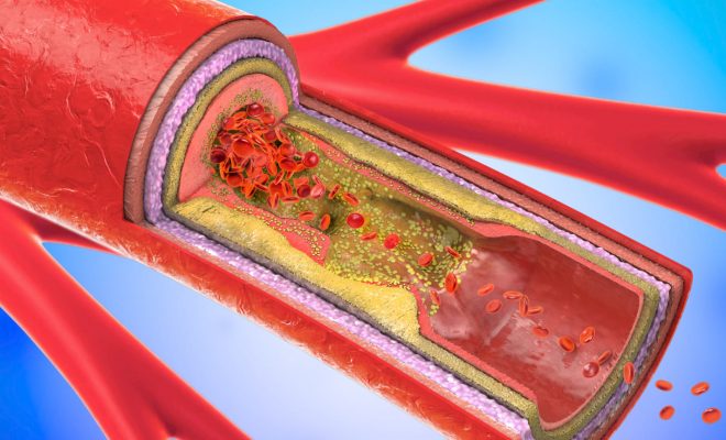 Poliarteritis nodosa: inflamación vascular como causa de la inflamación articular